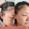 Hairline appearance comparison from week 1 to week 12