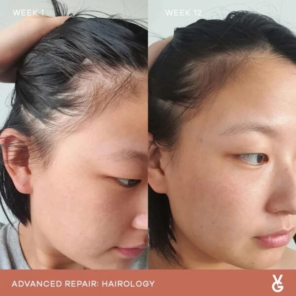 Hairline appearance comparison from week 1 to week 12