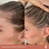 Hairline appearance comparison after 12 weeks