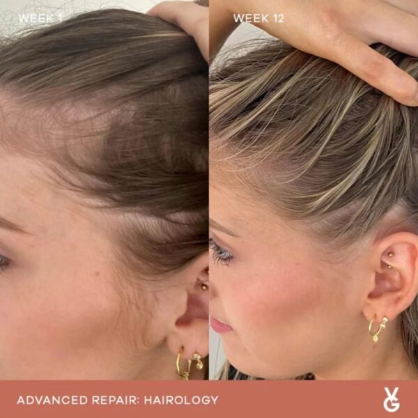 Hairline appearance comparison after 12 weeks